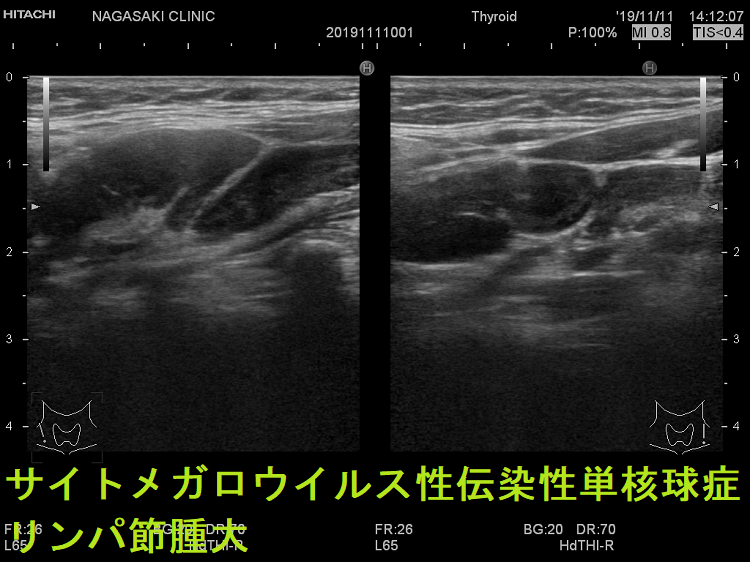 サイトメガロウイルス性伝染性単核球症 リンパ節反応性腫大(垂直断) 超音波(エコー)画像 サイトメガロウイルス性伝染性単核球症 リンパ節反応性腫大(垂直断) 超音波(エコー)画像