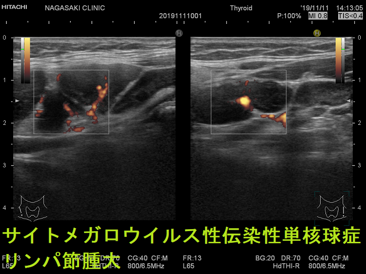 サイトメガロウイルス性伝染性単核球症 リンパ節反応性腫大(垂直断) 超音波(エコー)画像 ドプラーモード サイトメガロウイルス性伝染性単核球症 リンパ節反応性腫大(垂直断) 超音波(エコー)画像 ドプラーモード