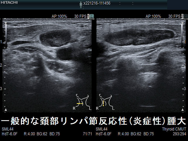 一般的な頚部リンパ節反応性(炎症性)腫大 超音波(エコー)画像 一般的な頚部リンパ節反応性(炎症性)腫大 超音波(エコー)画像