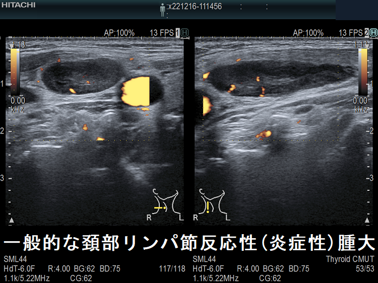 一般的な頚部リンパ節反応性(炎症性)腫大 超音波(エコー)画像ドプラーモード 一般的な頚部リンパ節反応性(炎症性)腫大 超音波(エコー)画像ドプラーモード