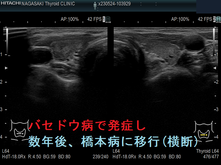 バセドウ病で発症し数年後、橋本病に移行(横断) バセドウ病で発症し数年後、橋本病に移行(横断)
