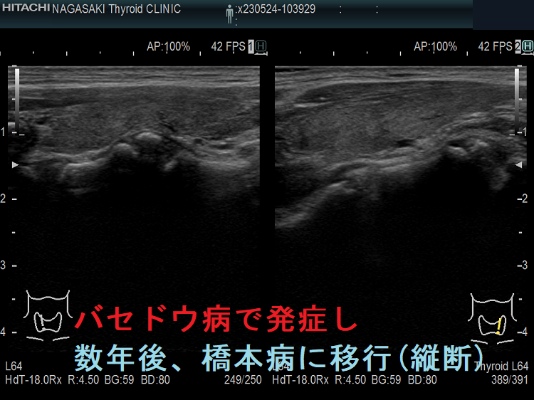 バセドウ病で発症し数年後、橋本病に移行(縦断) バセドウ病で発症し数年後、橋本病に移行(縦断)