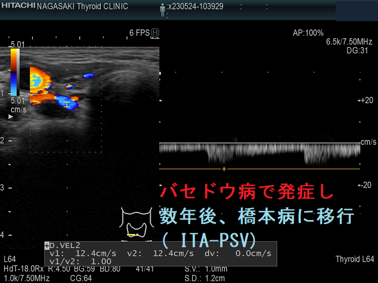 バセドウ病で発症し数年後、橋本病に移行( ITA-PSV) バセドウ病で発症し数年後、橋本病に移行( ITA-PSV)
