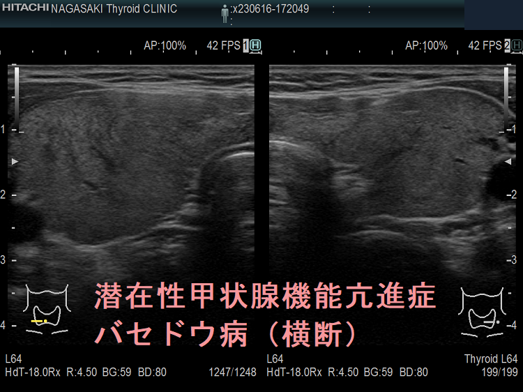 潜在性甲状腺機能亢進症 バセドウ病(横断) 潜在性甲状腺機能亢進症 バセドウ病(横断)