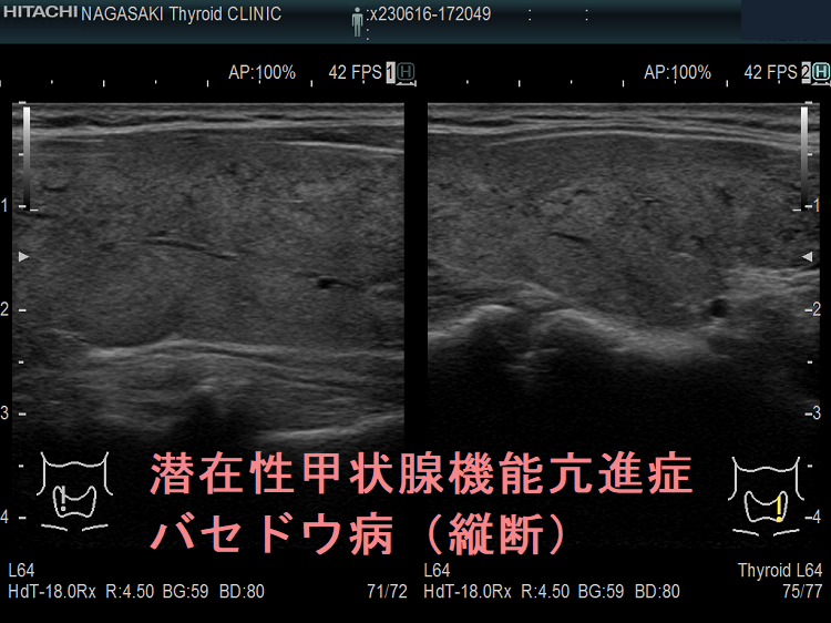 潜在性甲状腺機能亢進症 バセドウ病(縦断) 潜在性甲状腺機能亢進症 バセドウ病(縦断)
