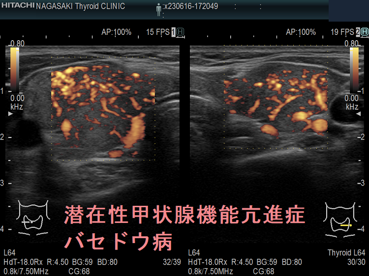 潜在性甲状腺機能亢進症 バセドウ病(横断)ドプラーモード 潜在性甲状腺機能亢進症 バセドウ病(横断)ドプラーモード
