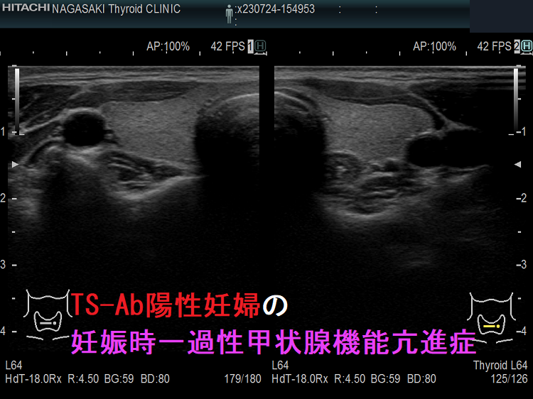 TS-Ab陽性妊婦の妊娠時一過性甲状腺機能亢進症 TS-Ab陽性妊婦の妊娠時一過性甲状腺機能亢進症
