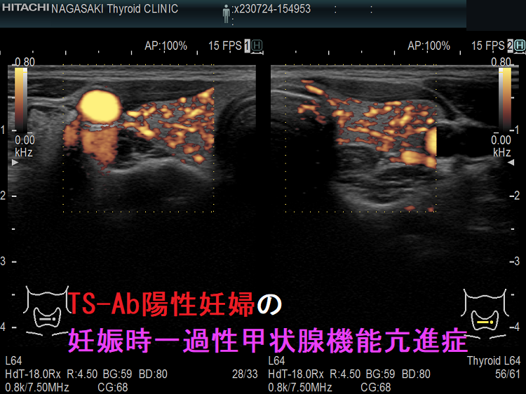 TS-Ab陽性妊婦の妊娠時一過性甲状腺機能亢進症 ドプラーモード TS-Ab陽性妊婦の妊娠時一過性甲状腺機能亢進症 ドプラーモード