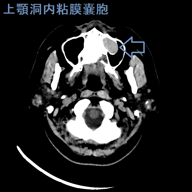 上顎洞内粘膜嚢胞 CT画像 (水平断) 上顎洞内粘膜嚢胞 CT画像 (水平断)