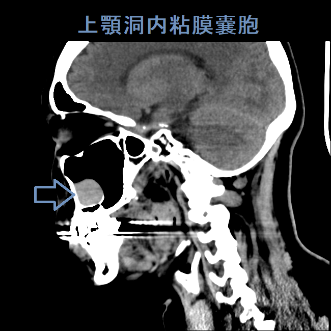 上顎洞内粘膜嚢胞 CT画像 (矢状断) 上顎洞内粘膜嚢胞 CT画像 (矢状断)