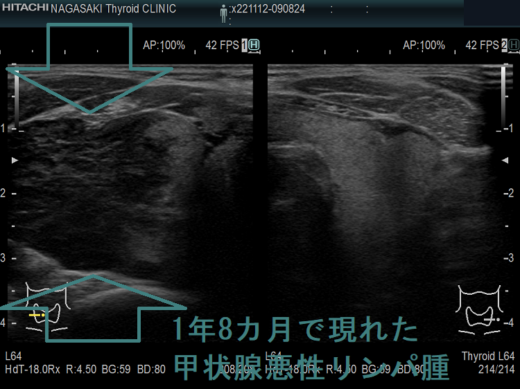 1年8カ月で現れた甲状腺悪性リンパ腫 1年8カ月で現れた甲状腺悪性リンパ腫