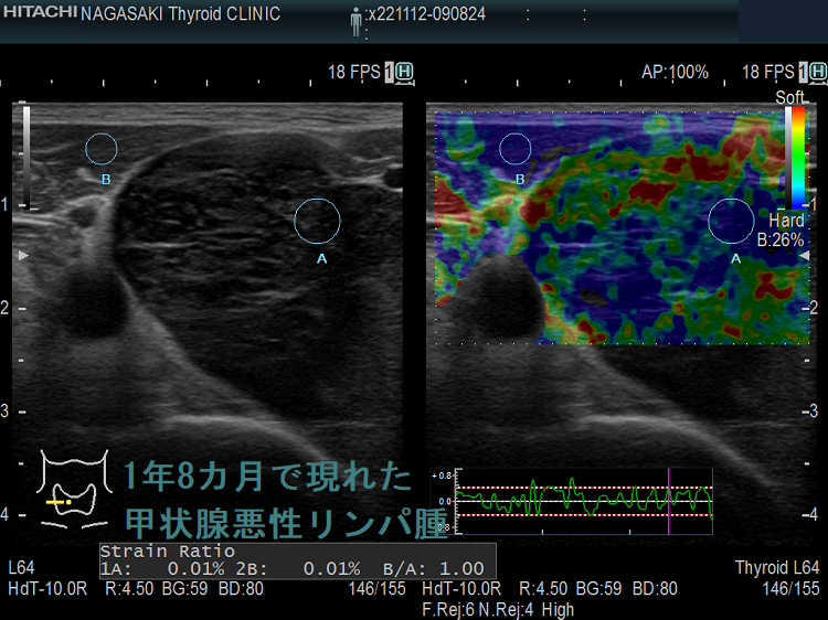 1年8カ月で現れた甲状腺悪性リンパ腫 ドプラーモード 1年8カ月で現れた甲状腺悪性リンパ腫 エラストグラフィー