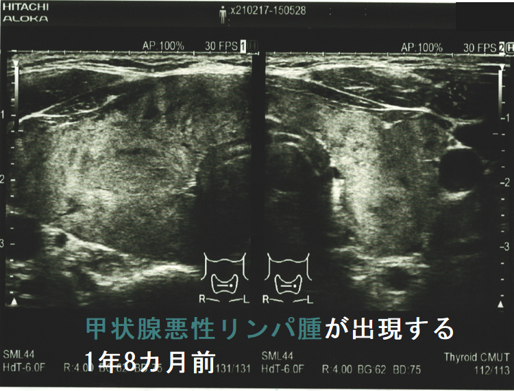 甲状腺悪性リンパ腫が出現する1年8カ月前 甲状腺悪性リンパ腫が出現する1年8カ月前