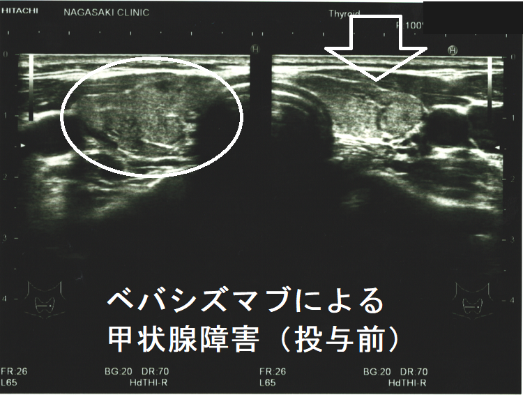 ベバシズマブによる甲状腺障害 投与前 超音波(エコー)画像 ベバシズマブによる甲状腺障害 投与前 超音波(エコー)画像