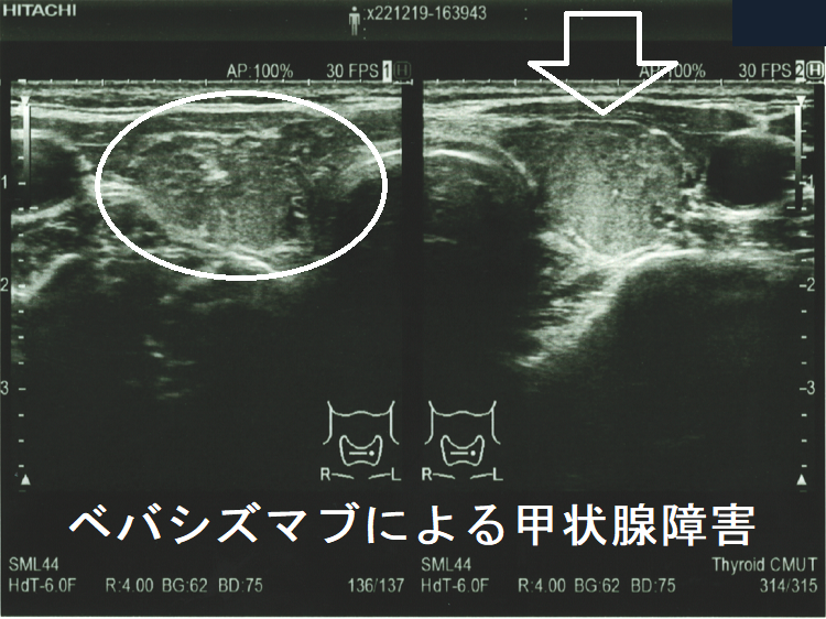ベバシズマブによる甲状腺障害 超音波(エコー)画像 ベバシズマブによる甲状腺障害 超音波(エコー)画像