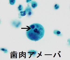 歯肉アメーバ 歯肉アメーバ