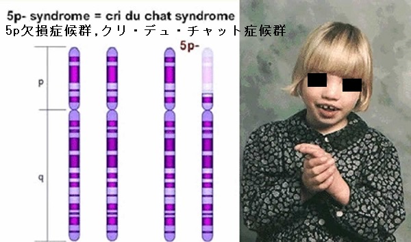 5p欠損症候群、クリ・デュ・チャット症候群 5p欠損症候群、クリ・デュ・チャット症候群