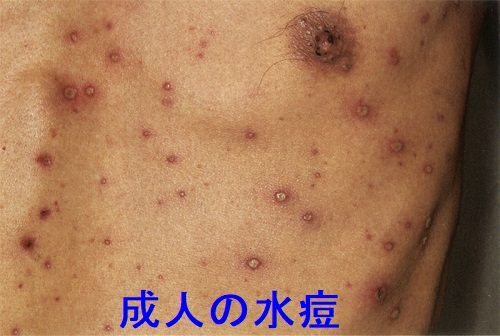 成人の水痘(拡大) 成人の水痘(拡大)