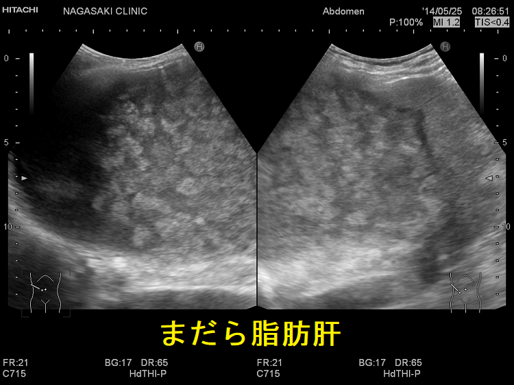まだら脂肪肝 超音波(エコー)画像1 まだら脂肪肝 超音波(エコー)画像1