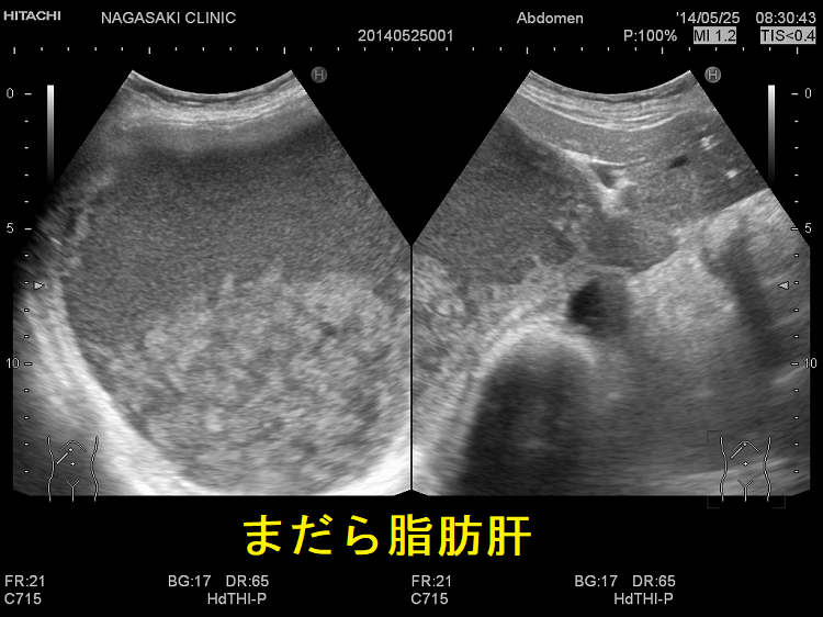 まだら脂肪肝 超音波(エコー)画像2 まだら脂肪肝 超音波(エコー)画像2