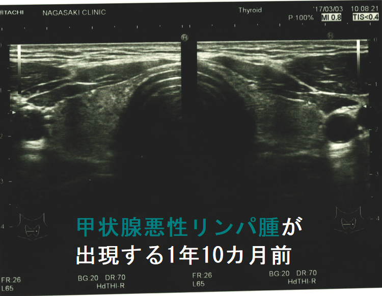 甲状腺悪性リンパ腫が出現する1年10カ月前 超音波(エコー)画像1 甲状腺悪性リンパ腫が出現する1年10カ月前 超音波(エコー)画像1