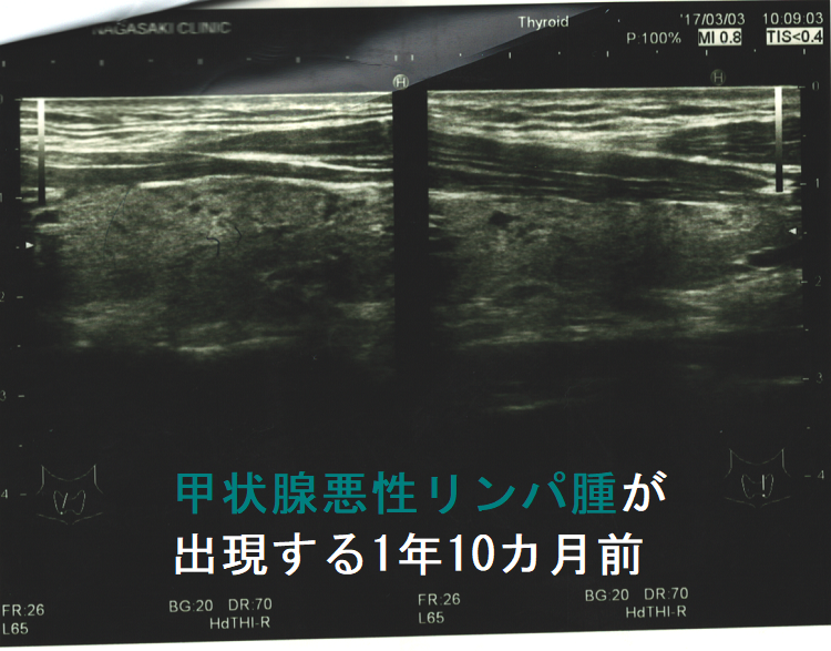 甲状腺悪性リンパ腫が出現する1年10カ月前 超音波(エコー)画像2 甲状腺悪性リンパ腫が出現する1年10カ月前 超音波(エコー)画像2