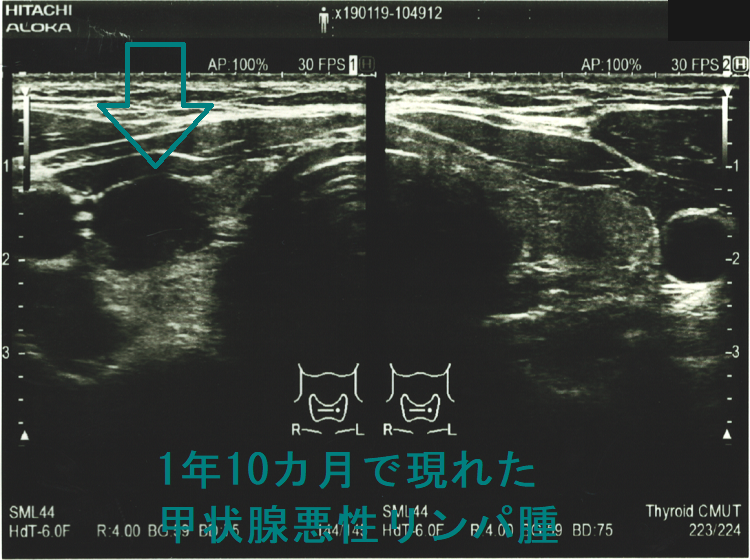 1年10カ月で現れた甲状腺悪性リンパ腫 超音波(エコー)画像1 1年10カ月で現れた甲状腺悪性リンパ腫 超音波(エコー)画像1