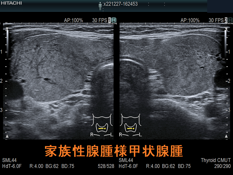 家族性腺腫様甲状腺腫(家族性多結節性甲状腺腫) 超音波(エコー)画像 家族性腺腫様甲状腺腫(家族性多結節性甲状腺腫) 超音波(エコー)画像
