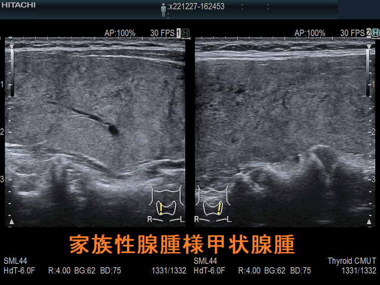 家族性腺腫様甲状腺腫 超音波(エコー)画像2 家族性腺腫様甲状腺腫 超音波(エコー)画像2