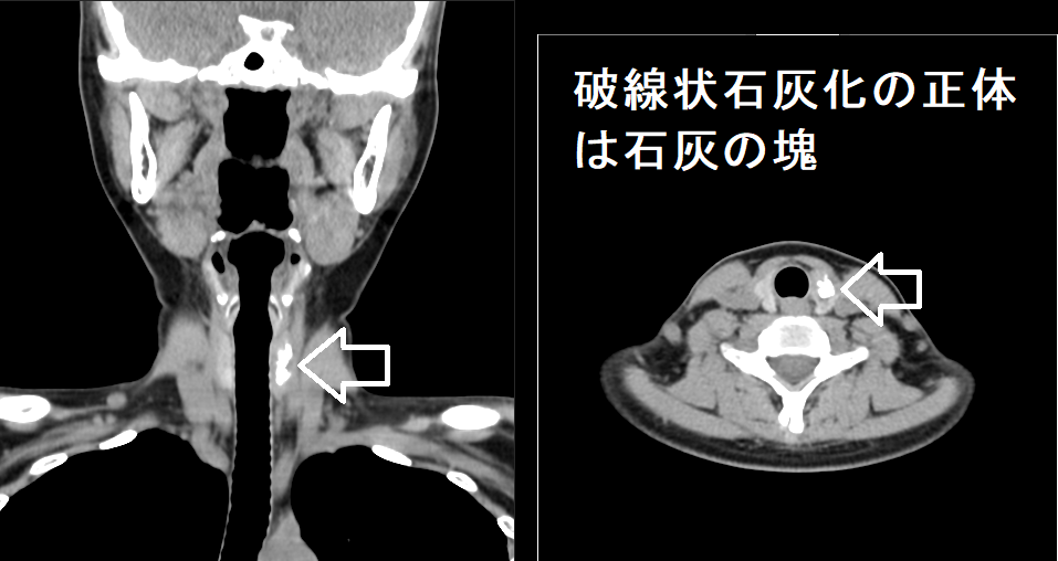 甲状腺腫瘍内の破線上石灰化の正体は石灰の塊 甲状腺腫瘍内の破線上石灰化の正体は石灰の塊