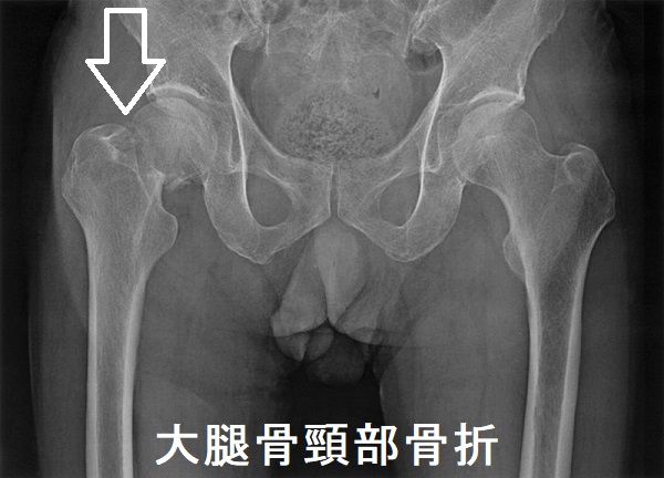 大腿骨頸部骨折 大腿骨頸部骨折