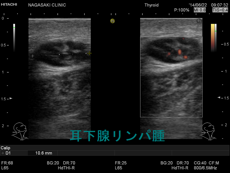 耳下腺リンパ腫 超音波(エコー)画像 耳下腺リンパ腫 超音波(エコー)画像