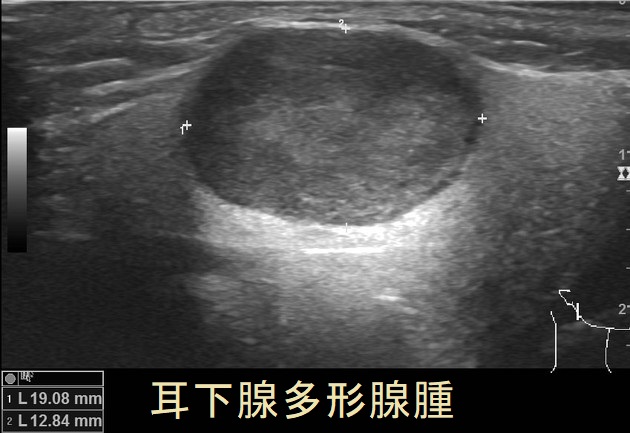 耳下腺多形腺腫 超音波(エコー)画像 耳下腺多形腺腫 超音波(エコー)画像