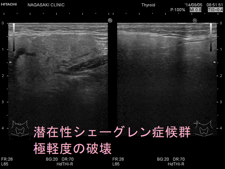 潜在性シェーグレン症候群 極軽度の破壊と腫大 潜在性シェーグレン症候群 極軽度の破壊と腫大