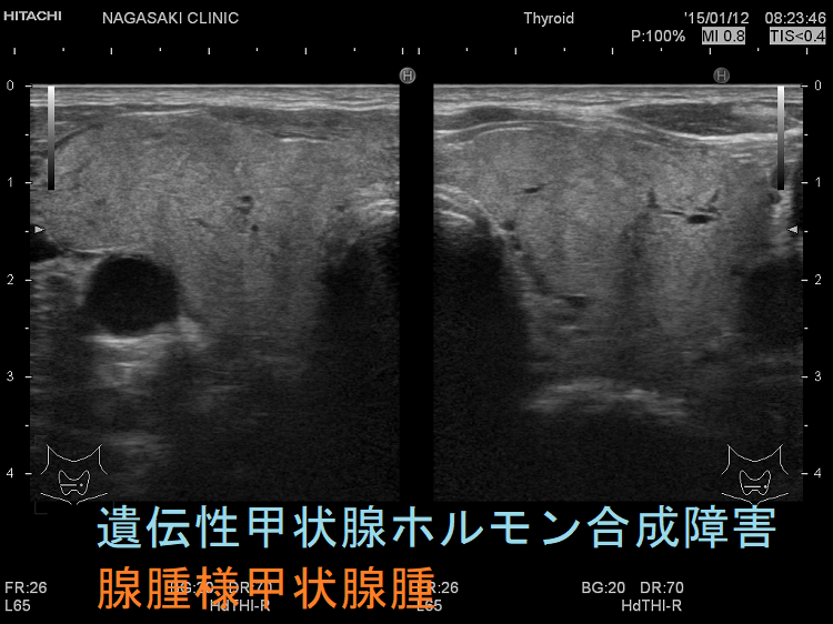 遺伝性甲状腺ホルモン合成障害 腺腫様甲状腺腫 遺伝性甲状腺ホルモン合成障害 腺腫様甲状腺腫