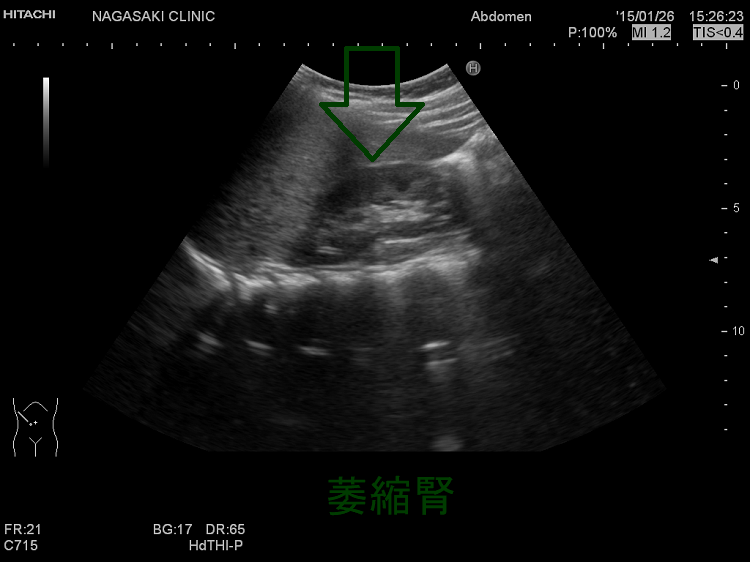 末期腎不全・透析・腎移植と甲状腺[橋本病 バセドウ病 エコー検査