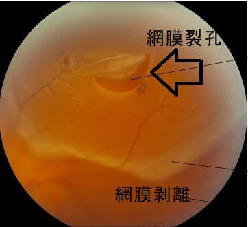 網膜裂孔 網膜剝離 網膜裂孔 網膜剝離