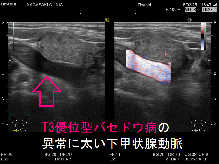 T3優位型バセドウ病の異常に太い下甲状腺動脈 T3優位型バセドウ病の異常に太い下甲状腺動脈