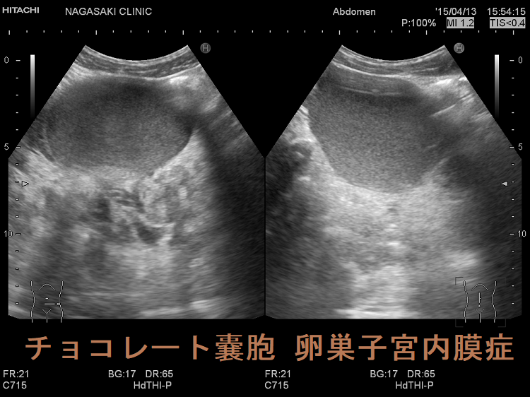 チョコレート嚢胞 卵巣子宮内膜症 超音波画像 チョコレート嚢胞 卵巣子宮内膜症 超音波画像
