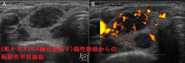 EML4-ALK(ALK融合遺伝子)陽性の肺癌からの転移性甲状腺癌 超音波(エコー)画像 EML4-ALK(ALK融合遺伝子)陽性の肺癌からの転移性甲状腺癌 超音波(エコー)画像