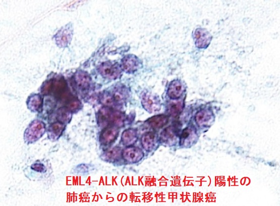 EML4-ALK(ALK融合遺伝子)陽性の肺癌からの転移性甲状腺癌 細胞診 EML4-ALK(ALK融合遺伝子)陽性の肺癌からの転移性甲状腺癌 細胞診