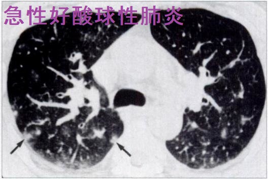 急性好酸球性肺炎 急性好酸球性肺炎