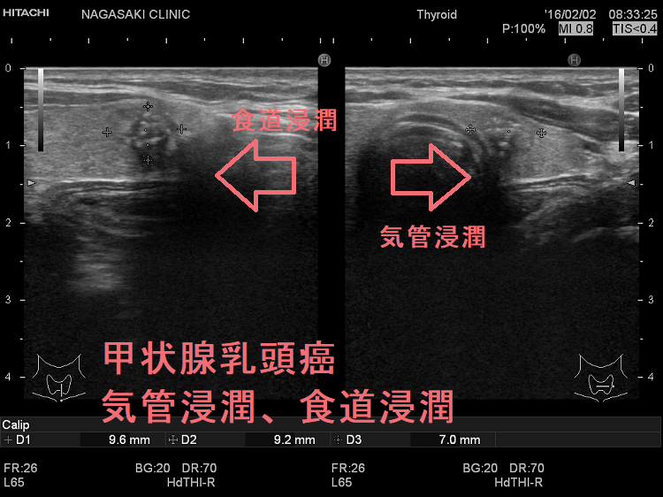 甲状腺乳頭癌 気管浸潤 食道浸潤 甲状腺乳頭癌 気管浸潤 食道浸潤
