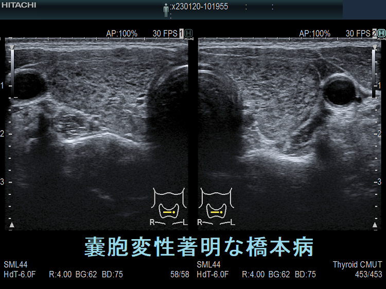 嚢胞変性著明な橋本病(慢性甲状腺炎) 嚢胞変性著明な橋本病(慢性甲状腺炎)
