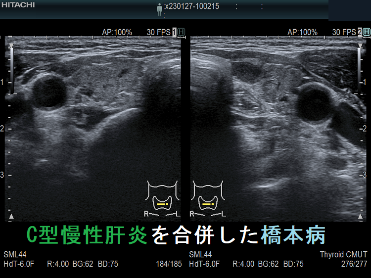 C型慢性肝炎を合併した橋本病(慢性甲状腺炎) C型慢性肝炎を合併した橋本病(慢性甲状腺炎)