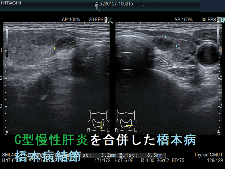 C型慢性肝炎を合併した橋本病(慢性甲状腺炎) 橋本病結節 C型慢性肝炎を合併した橋本病(慢性甲状腺炎) 橋本病結節