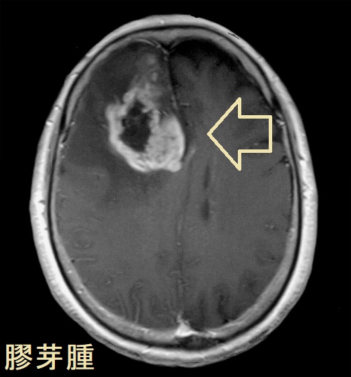 膠芽腫 造影MRI 膠芽腫 造影MRI