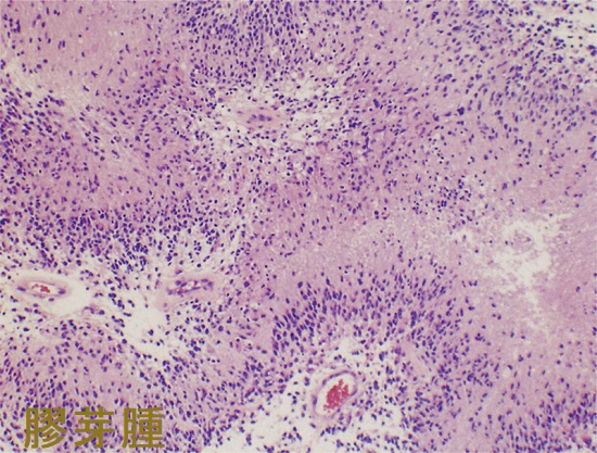 膠芽腫 組織像 膠芽腫 組織像