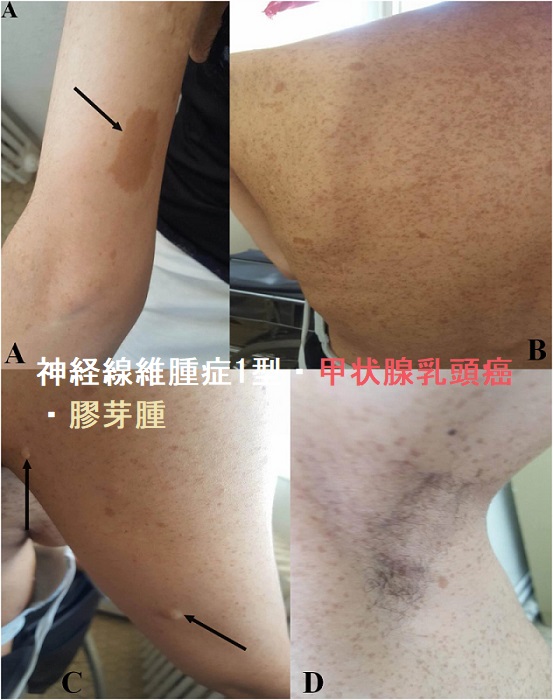 神経線維腫症1型・甲状腺乳頭癌・膠芽腫 神経線維腫症1型・甲状腺乳頭癌・膠芽腫