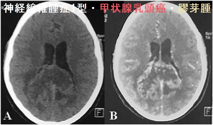 神経線維腫症1型・甲状腺乳頭癌・膠芽腫 造影CT 神経線維腫症1型・甲状腺乳頭癌・膠芽腫 造影CT